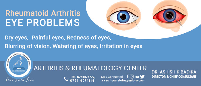 Rheumatoid Arthritis & Eye Problems - Dr. Ashish Badika, rheumatologyindore.com
