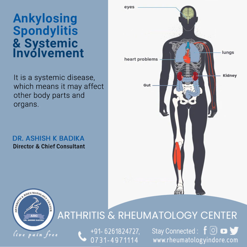 Ankylosing Spondylitis & Systemic Involvement - Dr. Ashish Badika, Arthritis & Rheumatology Center