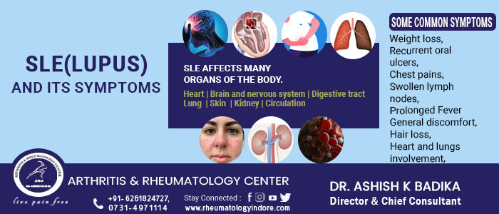 Systemic Lupus Erythematosus (SLE)/ Lupus, SLE Symptoms